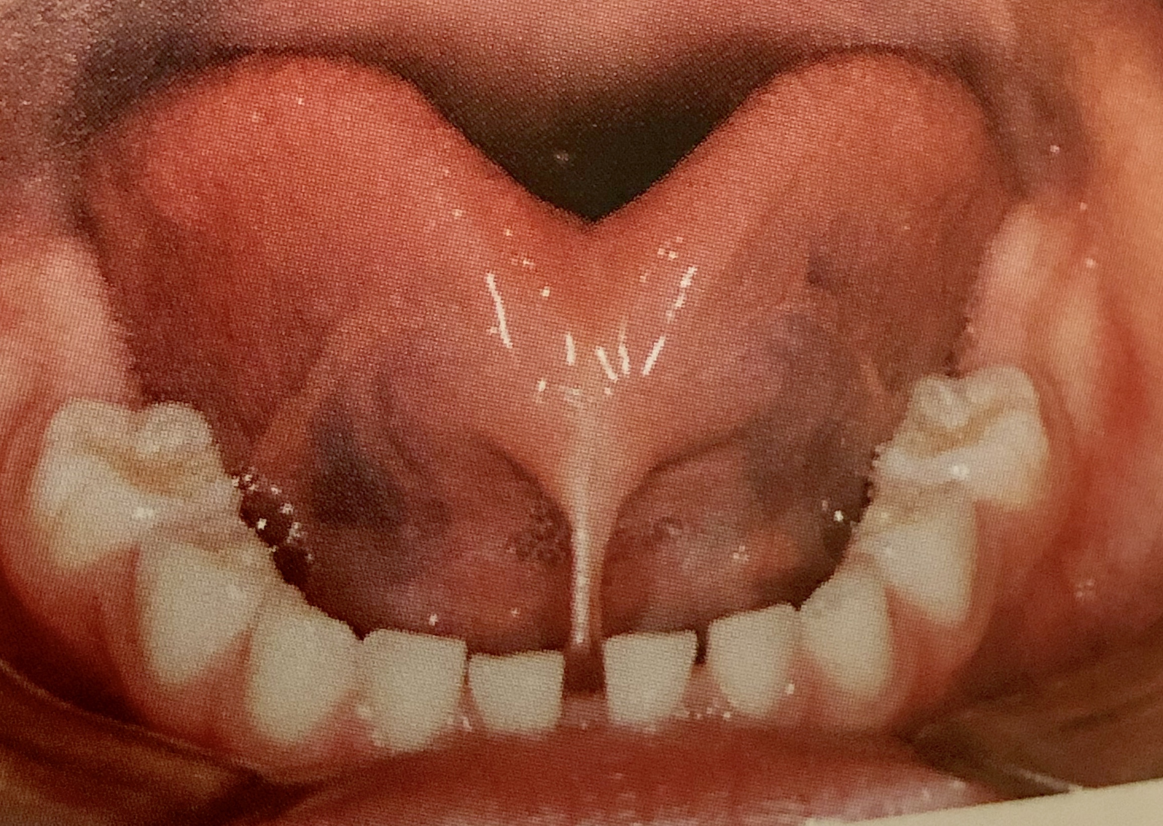 歯医者のつぶやき お子様が小帯付着異常と言われたら 墨田区京島の歯科 おそざわ歯科 曳舟駅 押上駅から徒歩約8分の歯医者