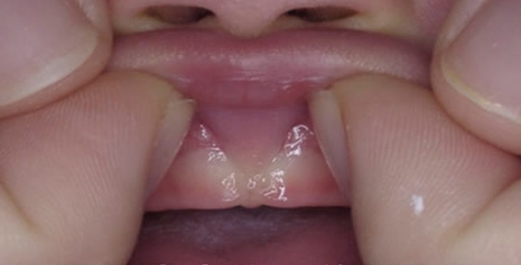 歯医者のつぶやき お子様が小帯付着異常と言われたら 墨田区京島の歯科 おそざわ歯科 曳舟駅 押上駅から徒歩約8分の歯医者